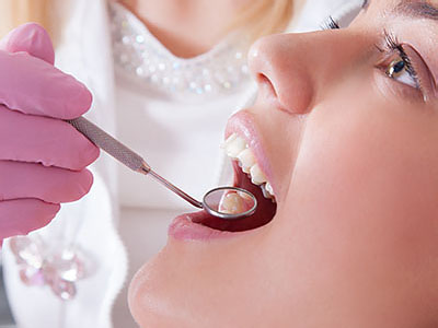 Dental Fillings Bloomington