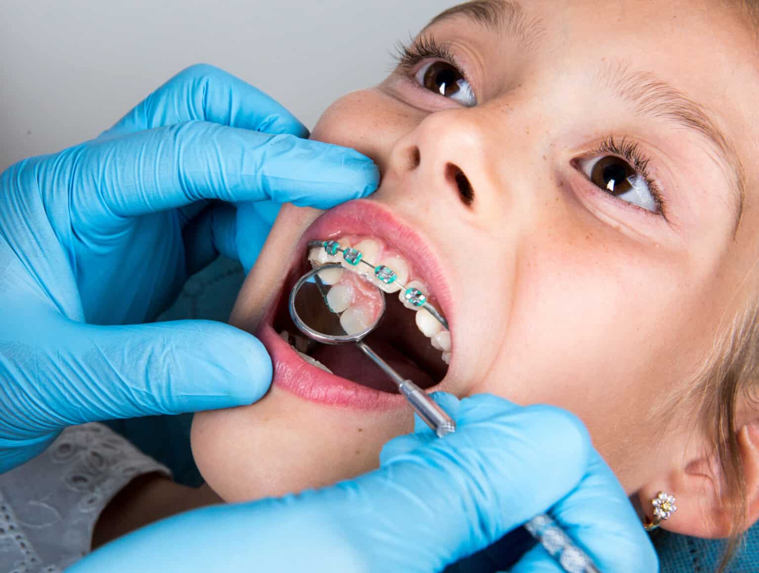 A child with braces undergoes a dental check-up, with blue-gloved hands using dental tools for examination.